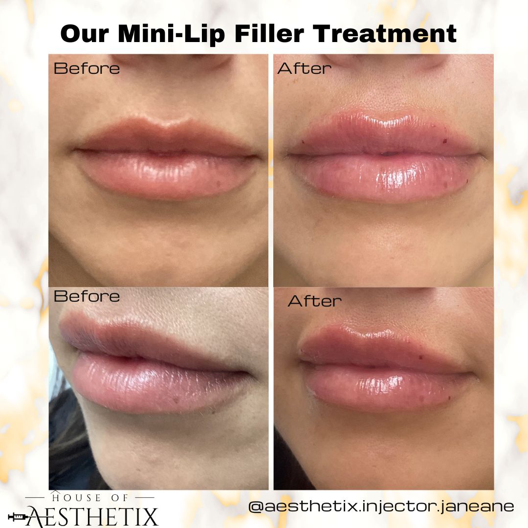 Understanding the Science Behind Lip Fillers: How Do They Work?